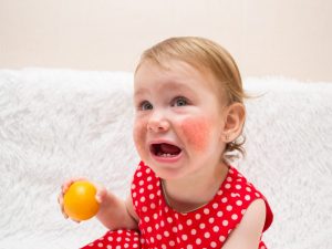 Citrus allergy symptoms